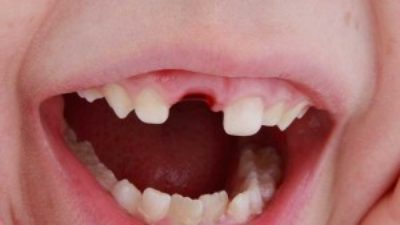 What Must Parents Do When a Child’s Tooth is Knocked Out?